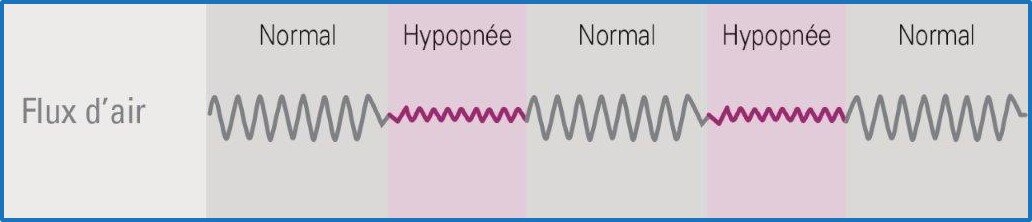 Hypopnée flux d'air