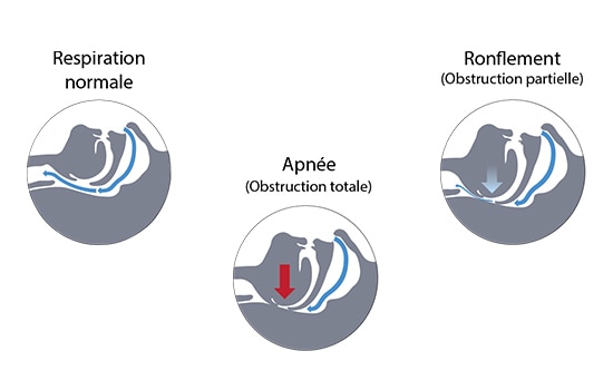schéma des voies aériennes pendant des troubles du sommeil