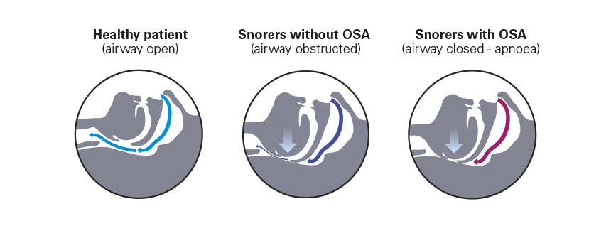 the-airway-when-you-snore-apnoea